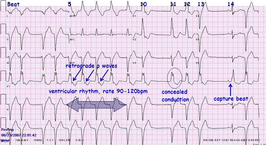 EKG with labels aivr.JPG. (click to enlarge). References: Rho RW, Page RL