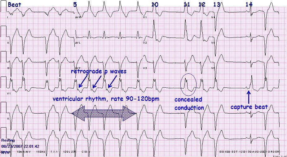 Taking all of these features into account, the complete rhythm diagnosis is 