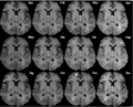 120px-monthly_multiple_sclerosis_mri.gif