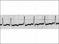 afib.jpg