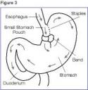 vertical_banded_gastroplasty.jpg