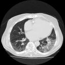 Chest CT 1