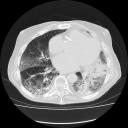 Chest CT 2