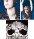 goiter2.jpg