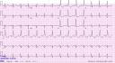 baseline_ekg.JPG