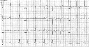 wellens2