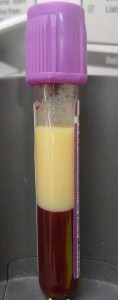 Hyperlipidaemia_-_lipid_in_EDTA_tube