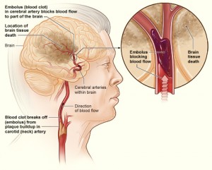 Stroke_ischemic