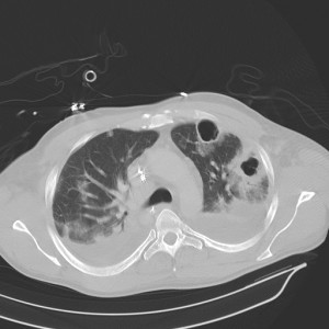 pneumonia_with_abscesses_caverns_and_effusions_d0